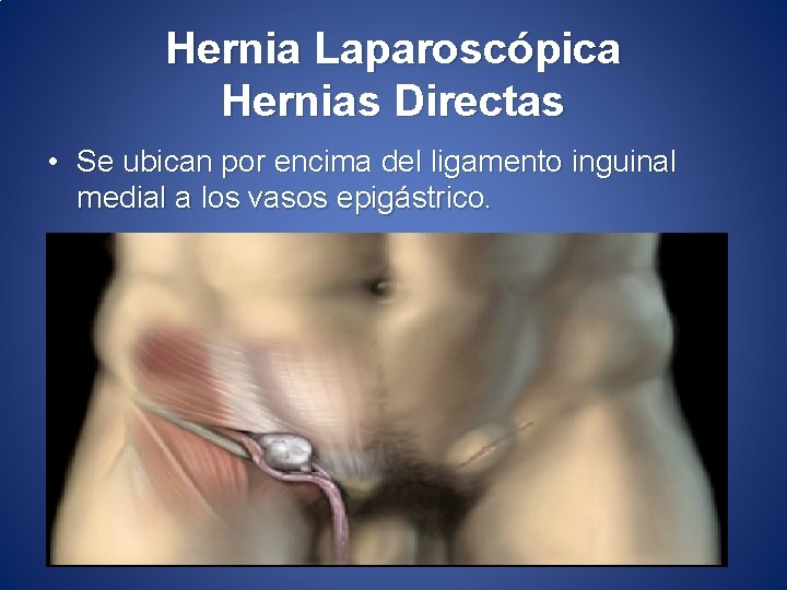 Hernia Laparoscópica Hernias Directas • Se ubican por encima del ligamento inguinal medial a