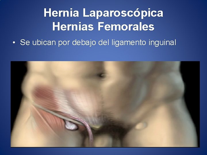 Hernia Laparoscópica Hernias Femorales • Se ubican por debajo del ligamento inguinal 