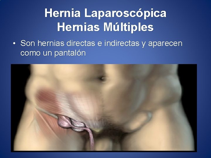 Hernia Laparoscópica Hernias Múltiples • Son hernias directas e indirectas y aparecen como un