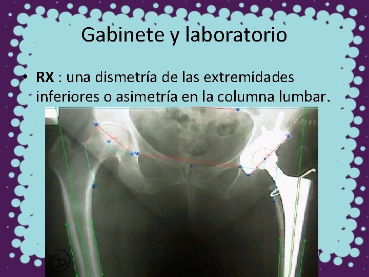 Gabinete y laboratorio • RX : una dismetría de las extremidades inferiores o asimetría