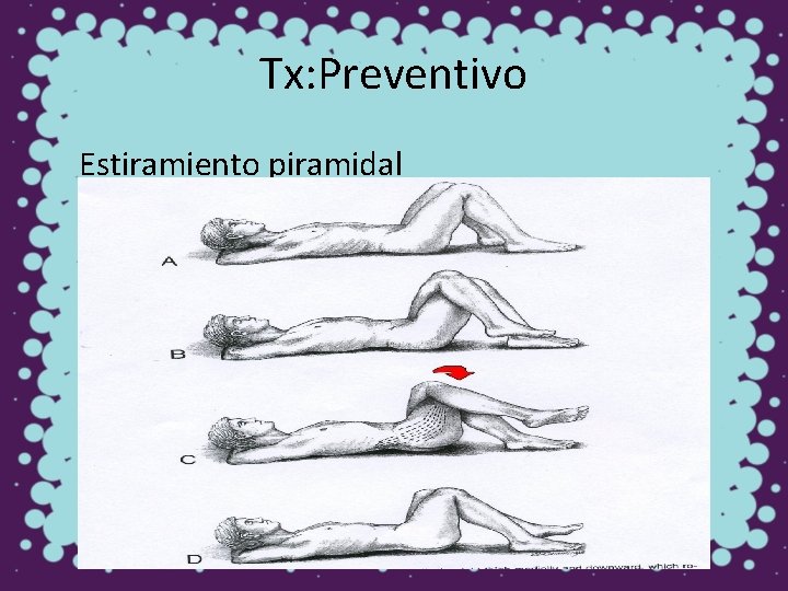 Tx: Preventivo Estiramiento piramidal 