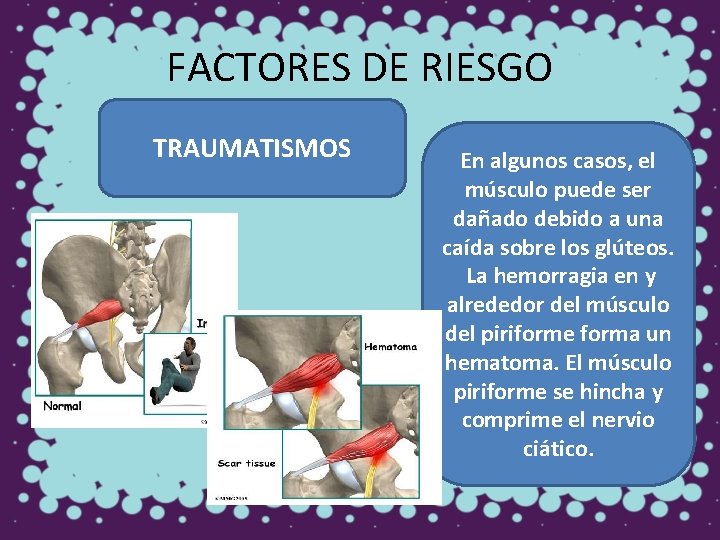 FACTORES DE RIESGO TRAUMATISMOS En algunos casos, el músculo puede ser dañado debido a