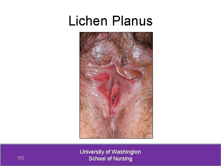 Lichen Planus 102 University of Washington School of Nursing 