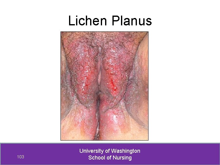 Lichen Planus 103 University of Washington School of Nursing 