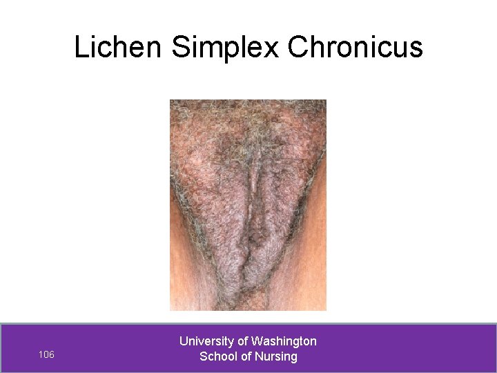 Lichen Simplex Chronicus 106 University of Washington School of Nursing 