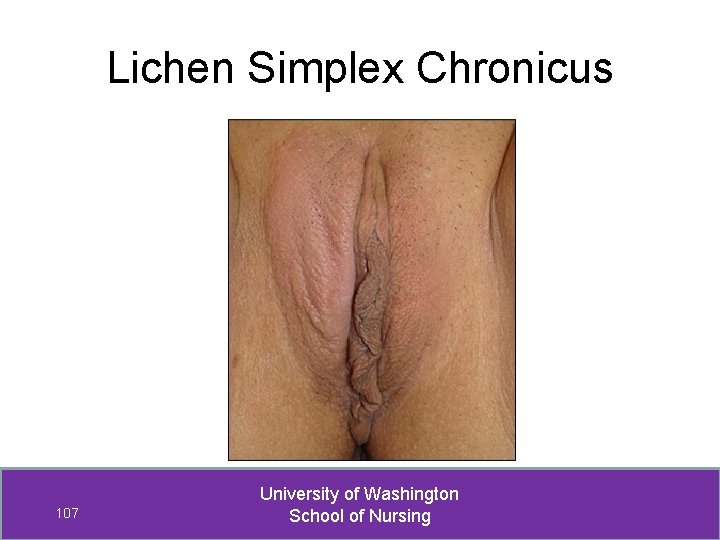 Lichen Simplex Chronicus 107 University of Washington School of Nursing 
