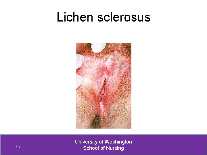 Lichen sclerosus 17 University of Washington School of Nursing 
