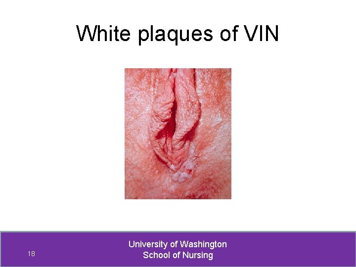 White plaques of VIN 18 University of Washington School of Nursing 