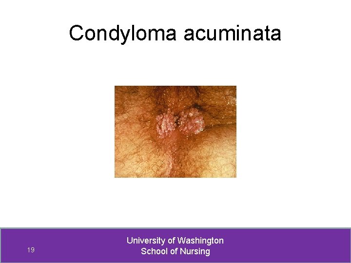 Condyloma acuminata 19 University of Washington School of Nursing 