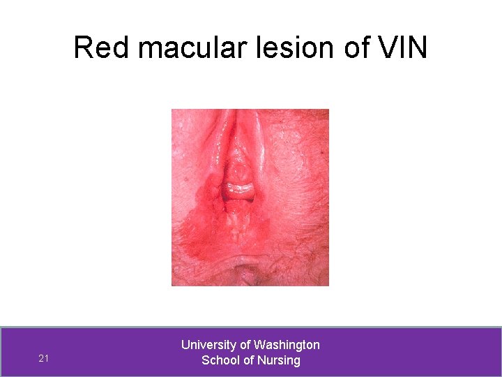 Red macular lesion of VIN 21 University of Washington School of Nursing 
