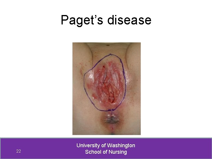 Paget’s disease 22 University of Washington School of Nursing 