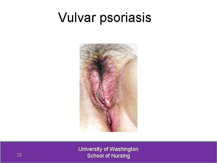 Vulvar psoriasis 23 University of Washington School of Nursing 