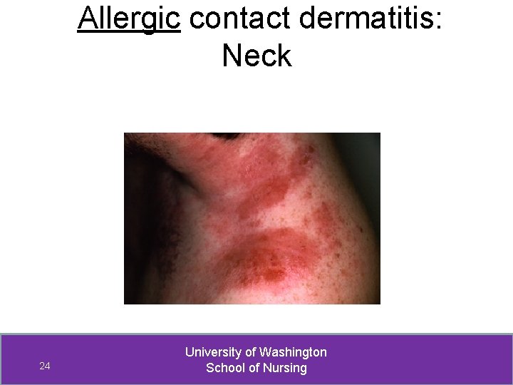 Allergic contact dermatitis: Neck 24 University of Washington School of Nursing 