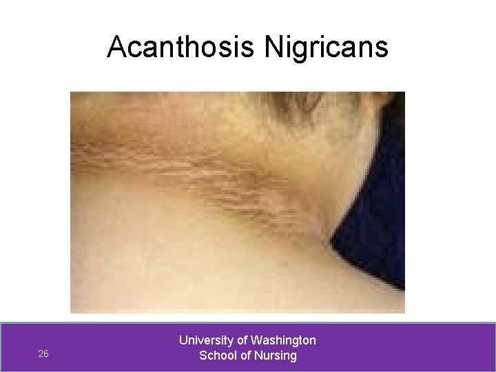 Acanthosis Nigricans 26 University of Washington School of Nursing 