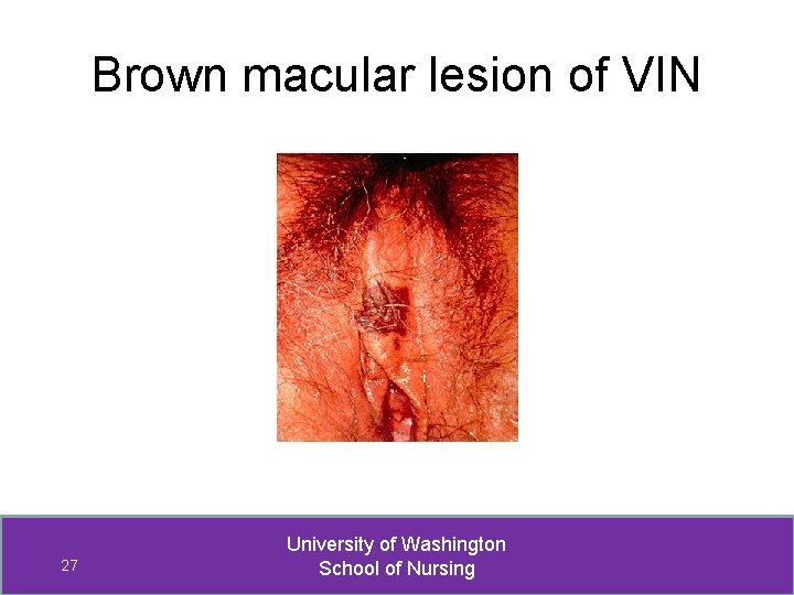 Brown macular lesion of VIN 27 University of Washington School of Nursing 