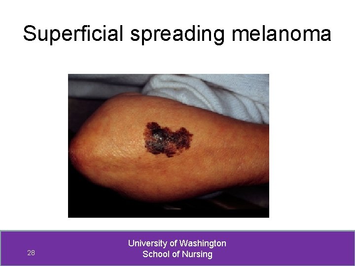 Superficial spreading melanoma 28 University of Washington School of Nursing 