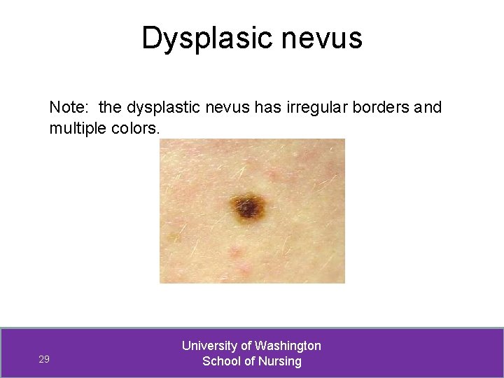 Dysplasic nevus Note: the dysplastic nevus has irregular borders and multiple colors. 29 University