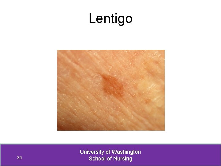 Lentigo 30 University of Washington School of Nursing 