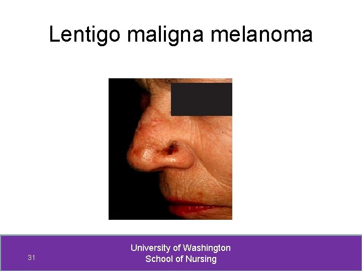 Lentigo maligna melanoma 31 University of Washington School of Nursing 