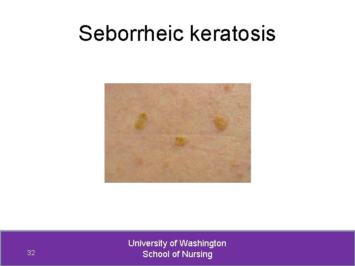 Seborrheic keratosis 32 University of Washington School of Nursing 