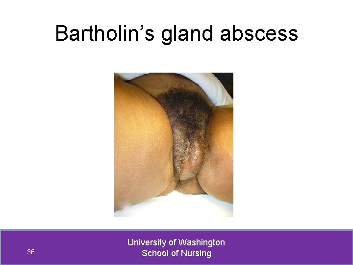 Bartholin’s gland abscess 36 University of Washington School of Nursing 