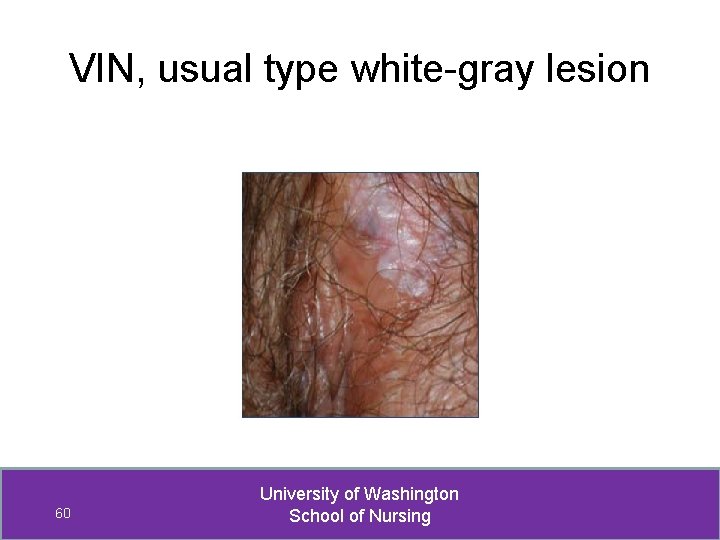 VIN, usual type white-gray lesion 60 University of Washington School of Nursing 