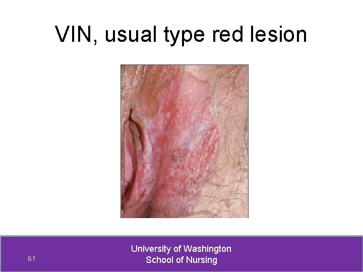 VIN, usual type red lesion 61 University of Washington School of Nursing 