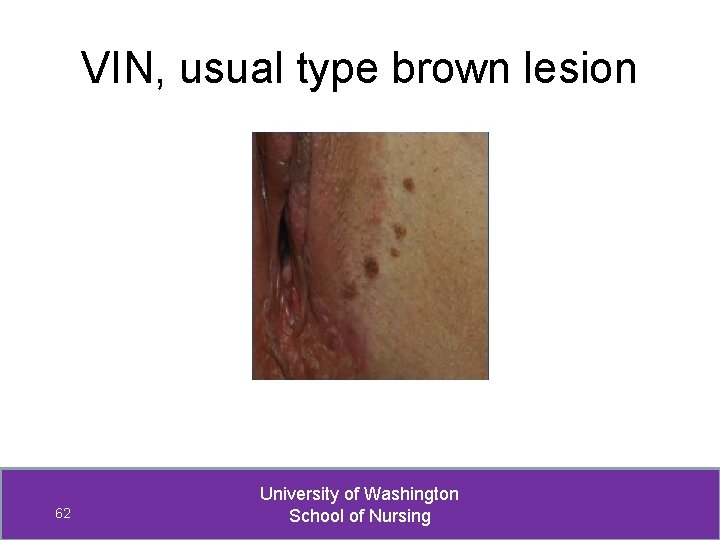 VIN, usual type brown lesion 62 University of Washington School of Nursing 