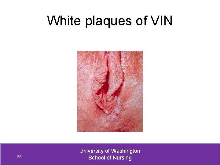 White plaques of VIN 65 University of Washington School of Nursing 