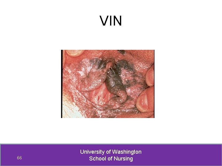 VIN 66 University of Washington School of Nursing 