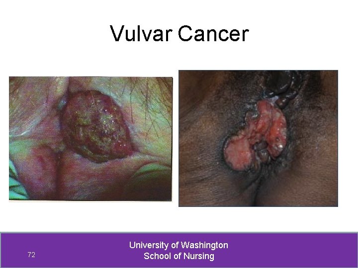 Vulvar Cancer 72 University of Washington School of Nursing 