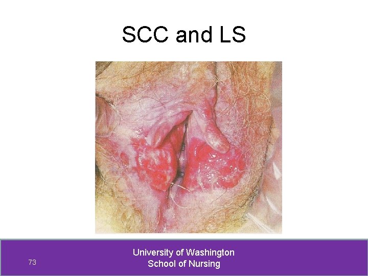 SCC and LS 73 University of Washington School of Nursing 