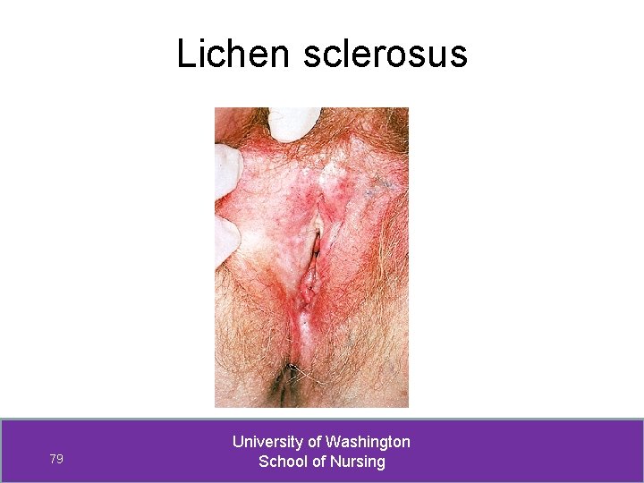 Lichen sclerosus 79 University of Washington School of Nursing 