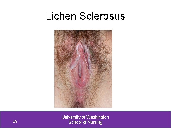 Lichen Sclerosus 80 University of Washington School of Nursing 