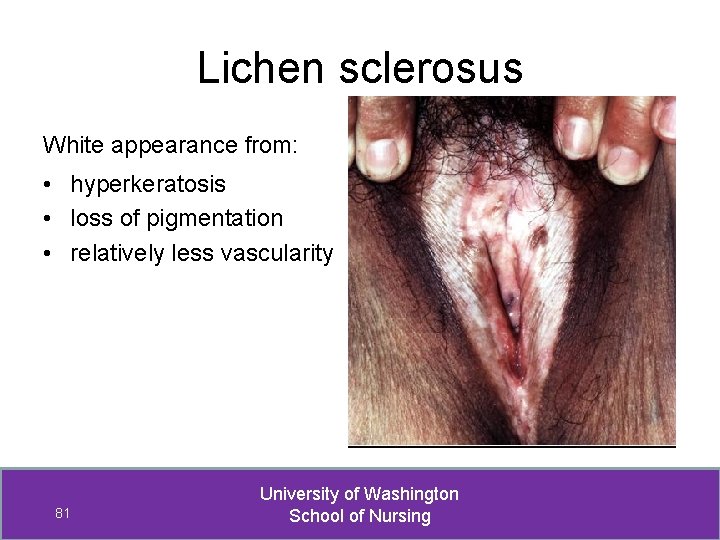 Lichen sclerosus White appearance from: • hyperkeratosis • loss of pigmentation • relatively less