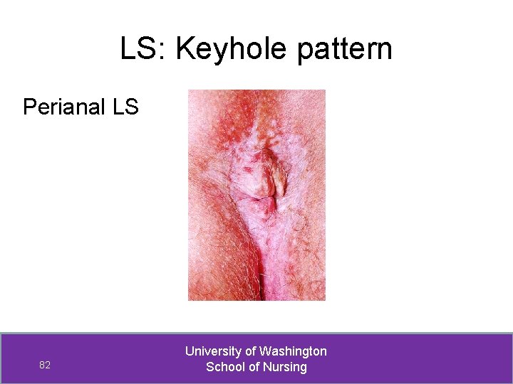 LS: Keyhole pattern Perianal LS 82 University of Washington School of Nursing 