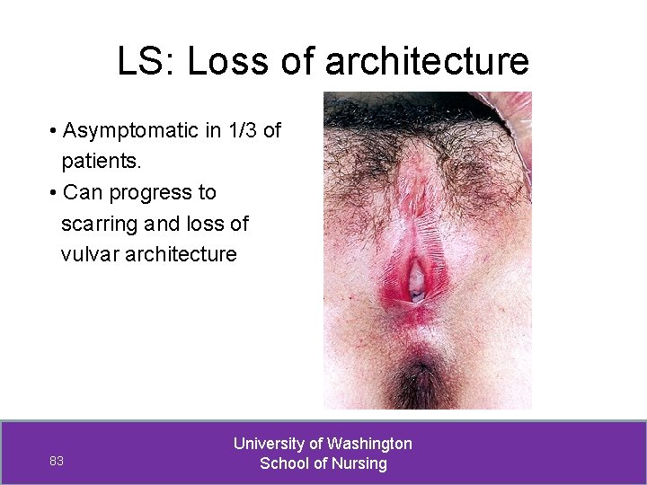 LS: Loss of architecture • Asymptomatic in 1/3 of patients. • Can progress to