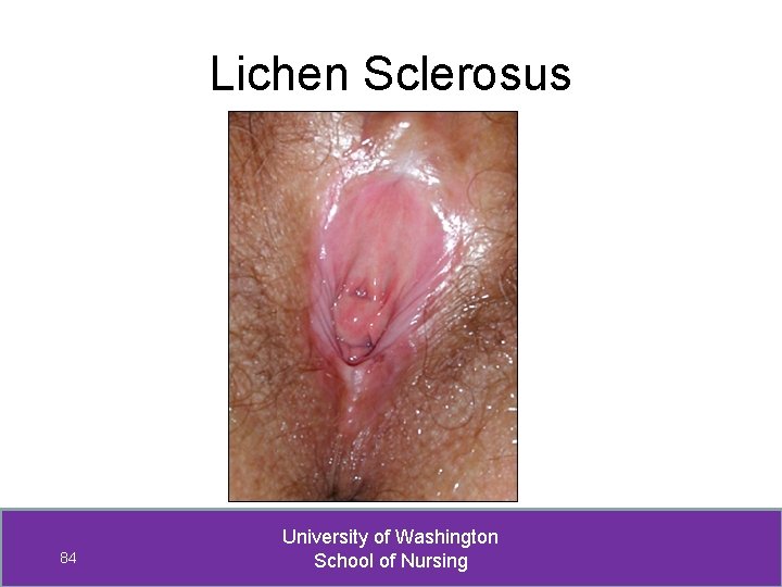 Lichen Sclerosus 84 University of Washington School of Nursing 