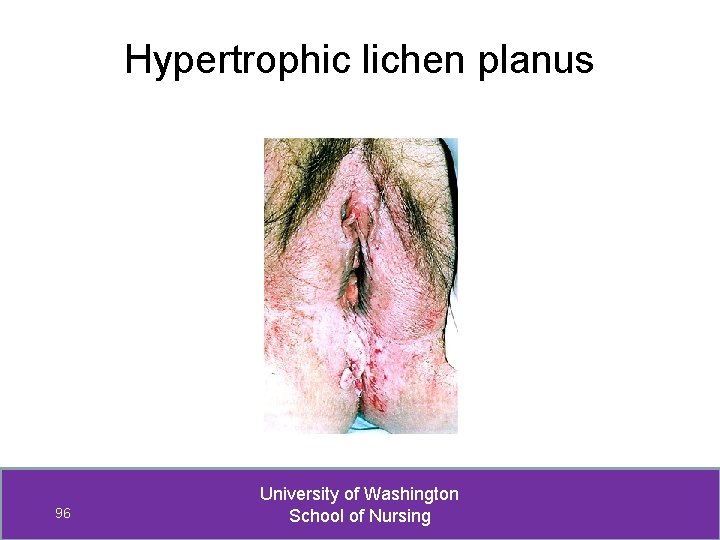 Hypertrophic lichen planus 96 University of Washington School of Nursing 