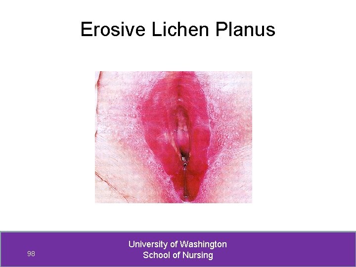 Erosive Lichen Planus 98 University of Washington School of Nursing 