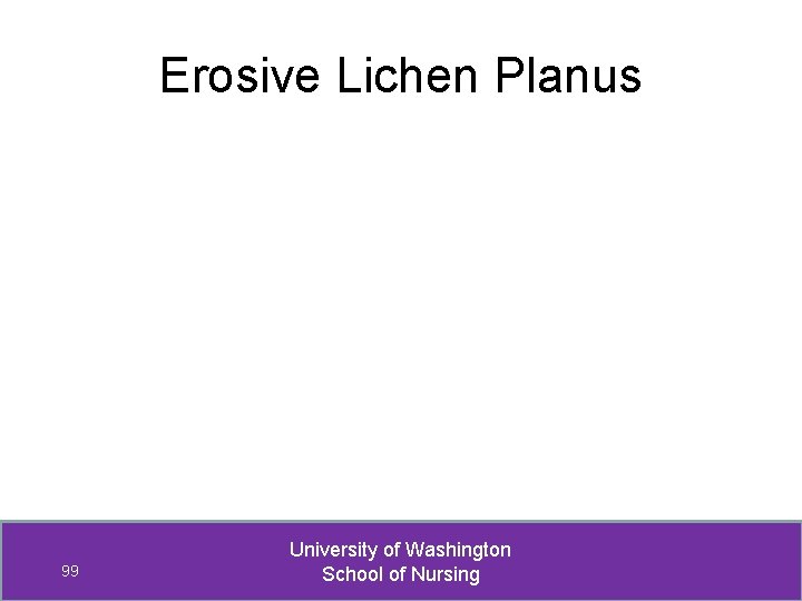 Erosive Lichen Planus 99 University of Washington School of Nursing 