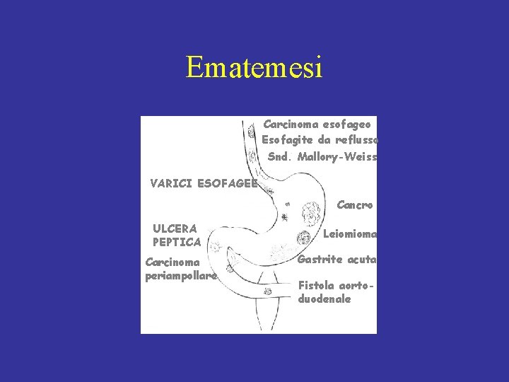 Ematemesi Carcinoma esofageo Esofagite da reflusso Snd. Mallory-Weiss VARICI ESOFAGEE Cancro ULCERA PEPTICA Carcinoma