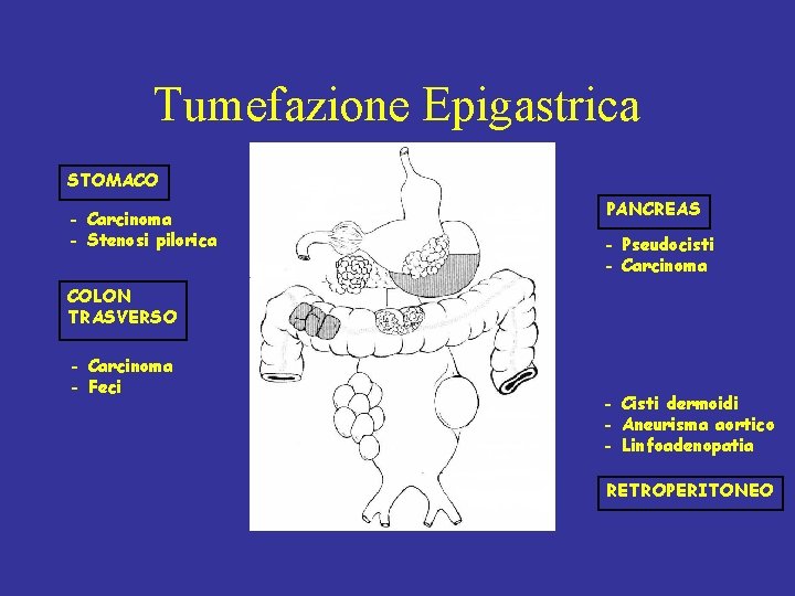 Tumefazione Epigastrica STOMACO - Carcinoma - Stenosi pilorica PANCREAS - Pseudocisti - Carcinoma COLON
