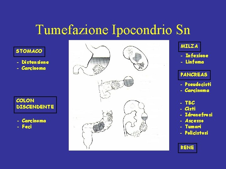 Tumefazione Ipocondrio Sn STOMACO - Distensione - Carcinoma MILZA - Infezione - Linfoma PANCREAS