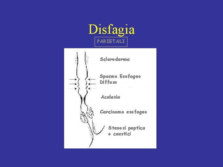Disfagia PARIETALI Scleroderma Spasmo Esofageo Diffuso Acalasia Carcinoma esofageo Stenosi peptica o caustici 