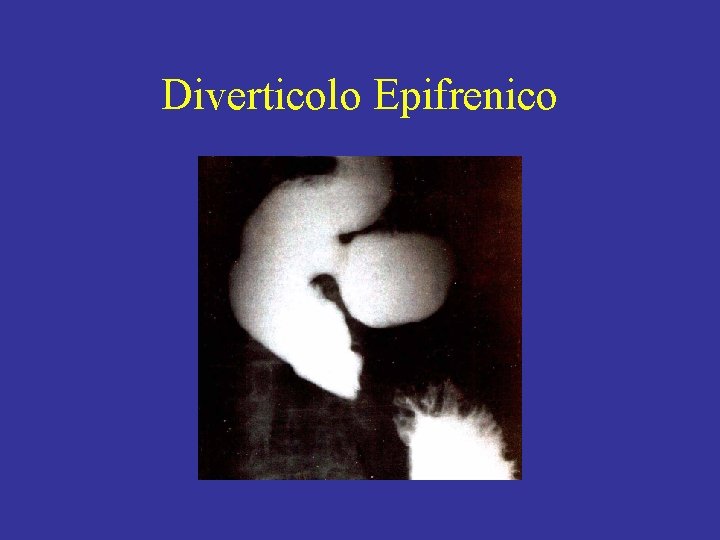 Diverticolo Epifrenico 