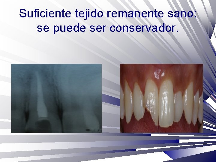 Suficiente tejido remanente sano: se puede ser conservador. 