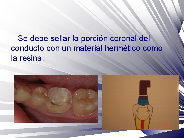 Se debe sellar la porción coronal del conducto con un material hermético como la