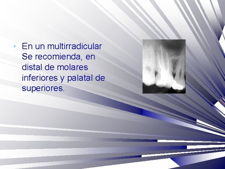  • En un multirradicular Se recomienda, en distal de molares inferiores y palatal