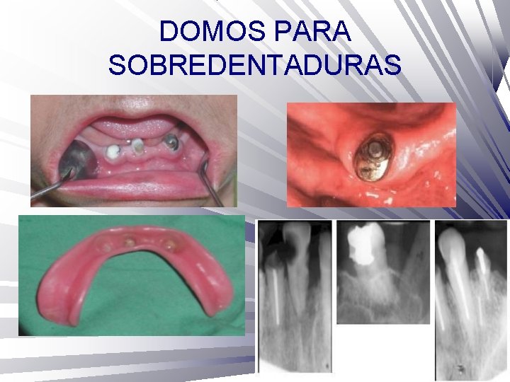 DOMOS PARA SOBREDENTADURAS 